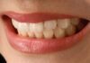 Porcelain Veneers
