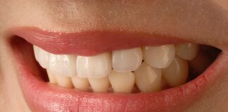 Porcelain Veneers