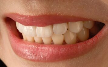 Porcelain Veneers: The Path to a Perfect Smile in Sydney Porcelain Veneers